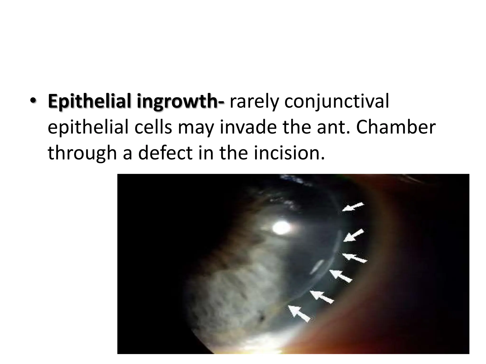 • Epithelial ingrowth- rarely conjunctival
epithelial cells may invade the ant. Chamber
through a defect in the incision.
 