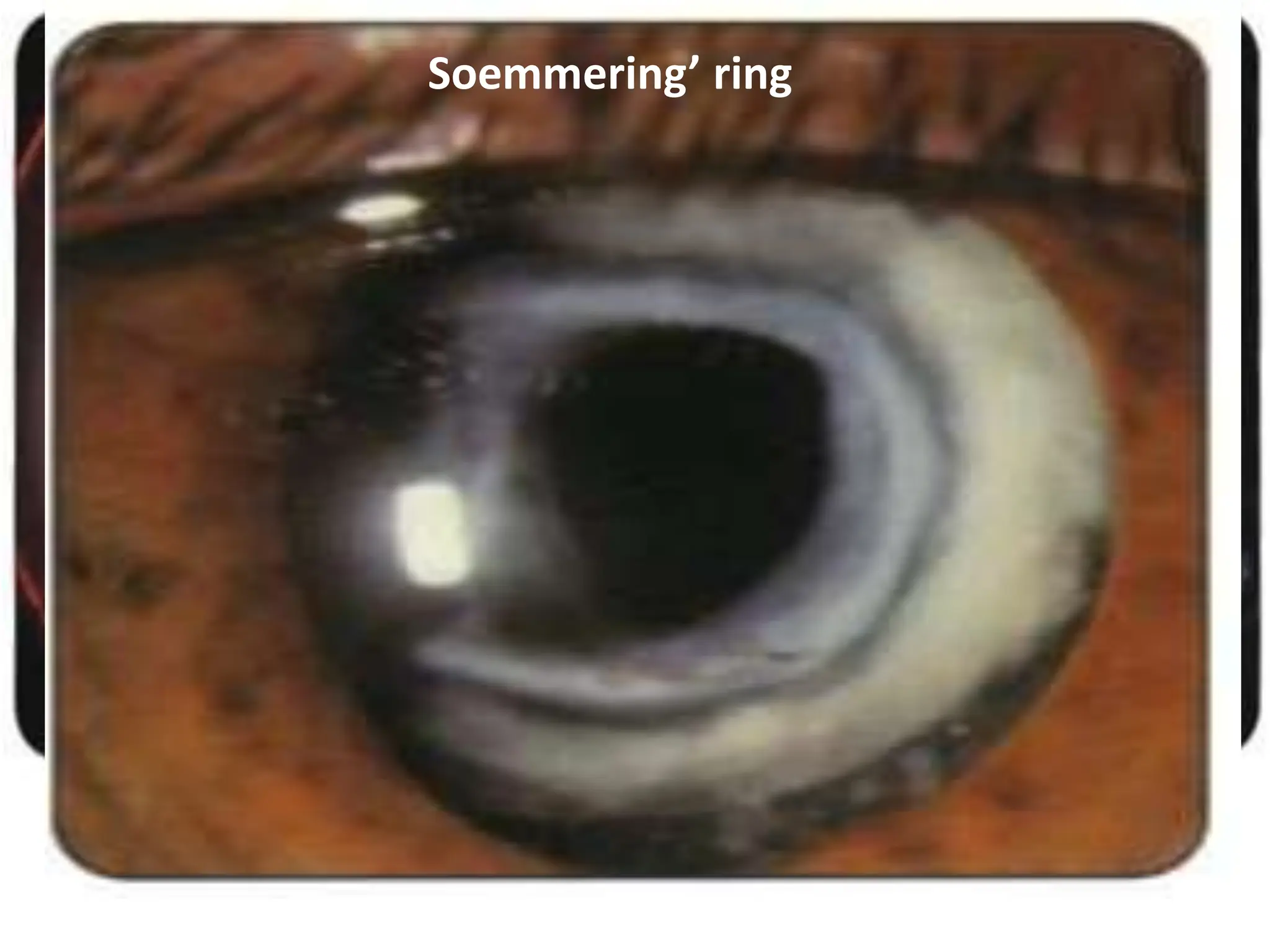 Capsule or dense membranous Elshning’s pearls-
Soemmering’ ring
 