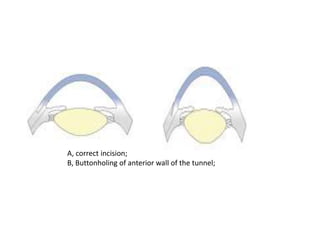 A, correct incision;
B, Buttonholing of anterior wall of the tunnel;
 