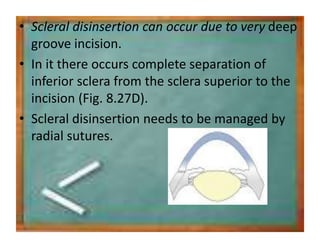 • Scleral disinsertion can occur due to very deep
groove incision.
• In it there occurs complete separation of
inferior sclera from the sclera superior to the
incision (Fig. 8.27D).
• Scleral disinsertion needs to be managed by
radial sutures.
 