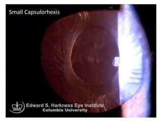 Small Capsulorhexis
 