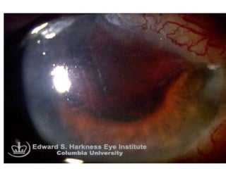 • (12) Expulsive choroidal haemorrhage.-
• It is one of the most dramatic and serious complications of
cataract surgery.
• It usually occurs in hypertensive and patients with
arteriosclerotic changes.
• It may occur during operation or during immediate
postoperative period.
• Its incidence was high in ICCE and conventional ECCE but
has decreased markedly with valvular incision of manual
SICS and phaco emulsification technique.
- Characterized by spontaneous gaping of the wound followed
by expulsion of the lens, vitreous, retina, uvea, & finally a gush
of bright red blood.
 