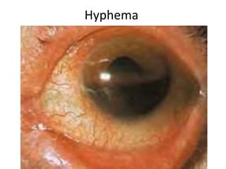 Hyphema
 
