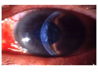 • (3) Striate keratopathy.- by mild corneal oedema
with descement's fold is a common complication
observed during immediate postoperative period.
- Due to endothelial damage during surgery.
• Management : Mild striate keratopathy usually
disappears spontaneously within a week.
Moderate to severe keratopathy may be treated
by instillation of hypertonic saline drops (5%
sodium chloride) along with steroids.
 