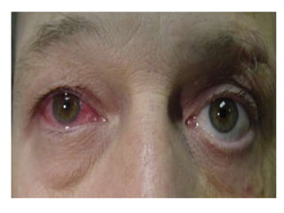 • (5) Postoperative anterior uveitis can be
induced by instrumental trauma, undue
handling of uveal tissue, reaction to residual
cortex or chemical reaction induced by
viscoelastics, pilocarpine etc.
• Management includes more aggressive use of
topical steroids, cycloplegics.
 