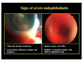 • Bacterial endophthalmitis- dreadful
complication with an incidence 0.2 to 0.5%.
- Sorce of infection- contaminated solution,
instruments, surgeon’s hands, pt’s own flora
from conjunctiva, eyelids, & air-borne
bacteria.
- Sign & symptom : ocular pain , diminished of
vision , corneal oedema
 