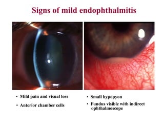 Signs of mild endophthalmitis
• Mild pain and visual loss
• Anterior chamber cells
• Small hypopyon
• Fundus visible with indirect
ophthalmoscope
 