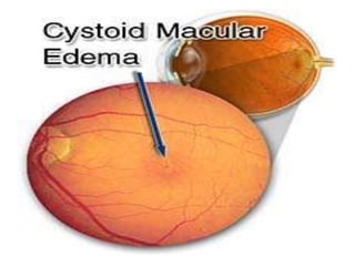 • CME- collection of fluid in the form of cystic
loculi in the henle’s layer of macula is a
frequent complication of cataract Surgery.
- On fundoscopy it gives a honeycomb
appearance.
- On FA- typical flower petal patterns due to
leakage of dye from perifoveal capillaries.
 