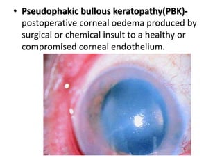 • Pseudophakic bullous keratopathy(PBK)-
postoperative corneal oedema produced by
surgical or chemical insult to a healthy or
compromised corneal endothelium.
 