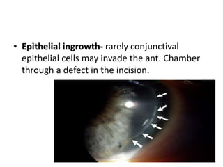 • Epithelial ingrowth- rarely conjunctival
epithelial cells may invade the ant. Chamber
through a defect in the incision.
 