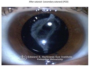After cataract- (secondary cataract) (PCO)
 