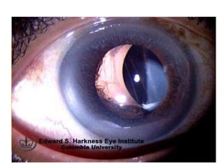 • Malposotion of IOL – decentration,
subluxation, & dislocation.
• Sun-set syndrome- infer. Subluxation of IOL
• Sun- rise syndrome-sup. Subluxation of IOL
• Lost lens syndrome- IOL into the vitreous
cavity
• Windshield wiper syndrome- IOL is places
vertically in the sulcus.
 
