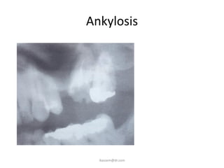Ankylosis
ikassem@dr.com
 