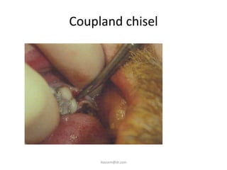 Coupland chisel
ikassem@dr.com
 