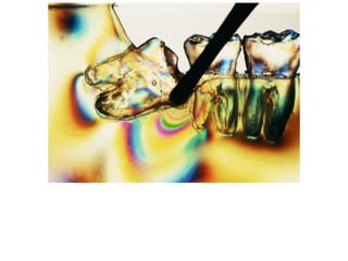 Photoelastic model of the mandible, showing the
development of stress during a luxation attempt of
the third molar when insufficient bone has been
removed from the tooth peripherally
 