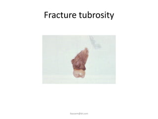 Fracture tubrosity
ikassem@dr.com
 