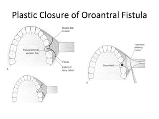 Plastic Closure of Oroantral Fistula
 