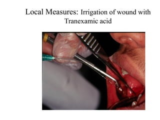 Local Measures: Irrigation of wound with
Tranexamic acid
 