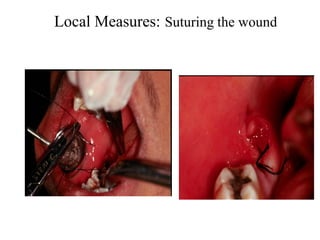Local Measures: Suturing the wound
 