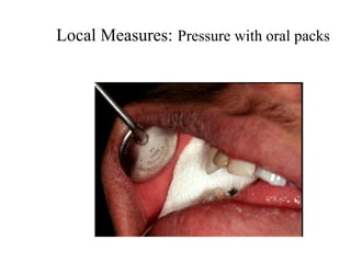 Local Measures: Pressure with oral packs
 