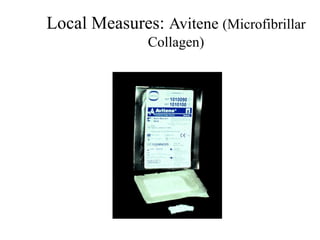 Local Measures: Avitene (Microfibrillar
Collagen)
 