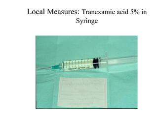 Local Measures: Tranexamic acid 5% in
Syringe
 