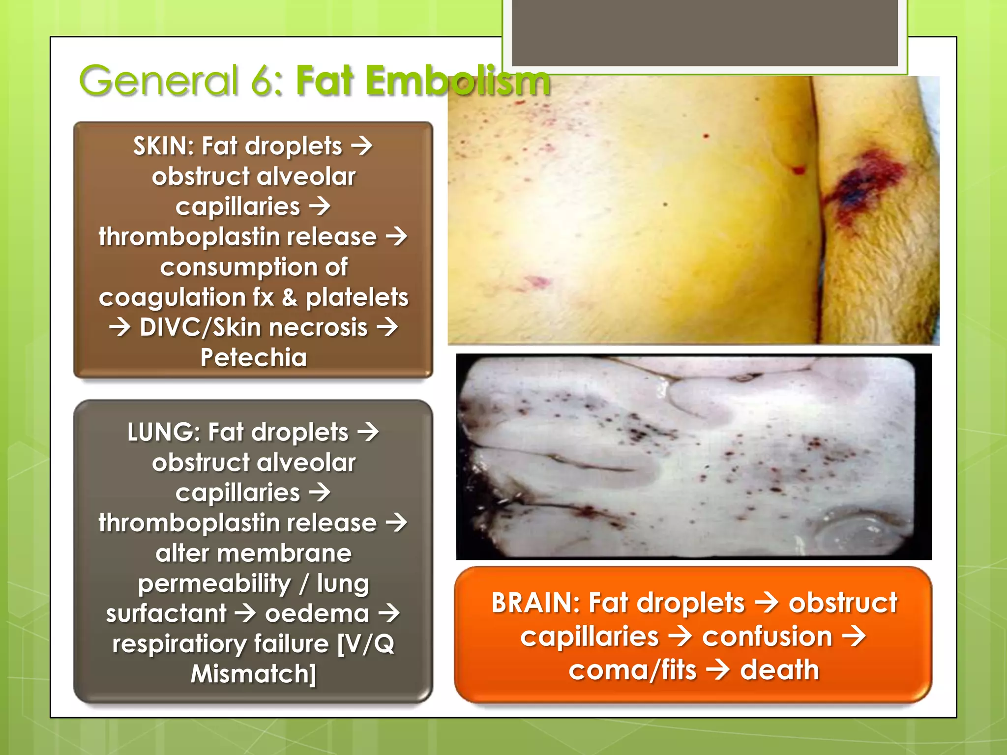 General 5: Deep vein thrombosis and pulmonary embolism.Virchow’s triad factor  Clot formation in large vein  thrombus breaks off  EmboliSite: leg, thigh and pelvic vein.Risk factors:
