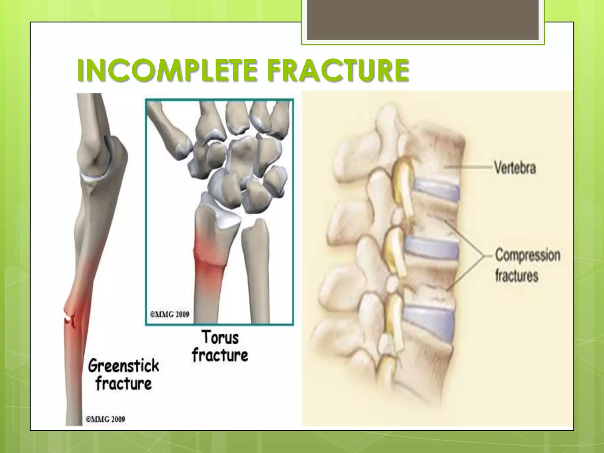 INCOMPLETE FRACTURE