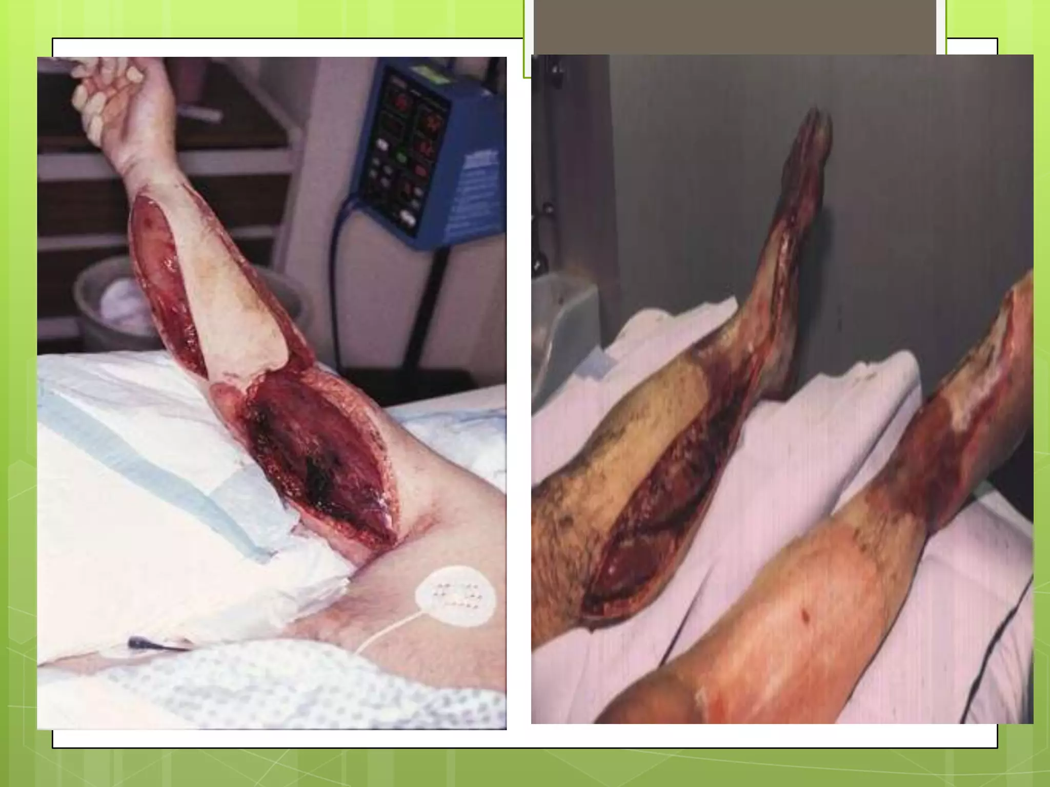 Investigations of compartment syndromesOther Ix – limited value; +ve only when CS is advancedPlasma creatinine and CPKUrinanalysis – myoglobinuriaNerve conduction studies Ix to establish underlying cause or exclude differentialsX-ray of affected extremity Doppler US/arteriograms – determine presence of pulses; exclude vascular injuries and DVTPT/APTT – exclude bleeding disorder