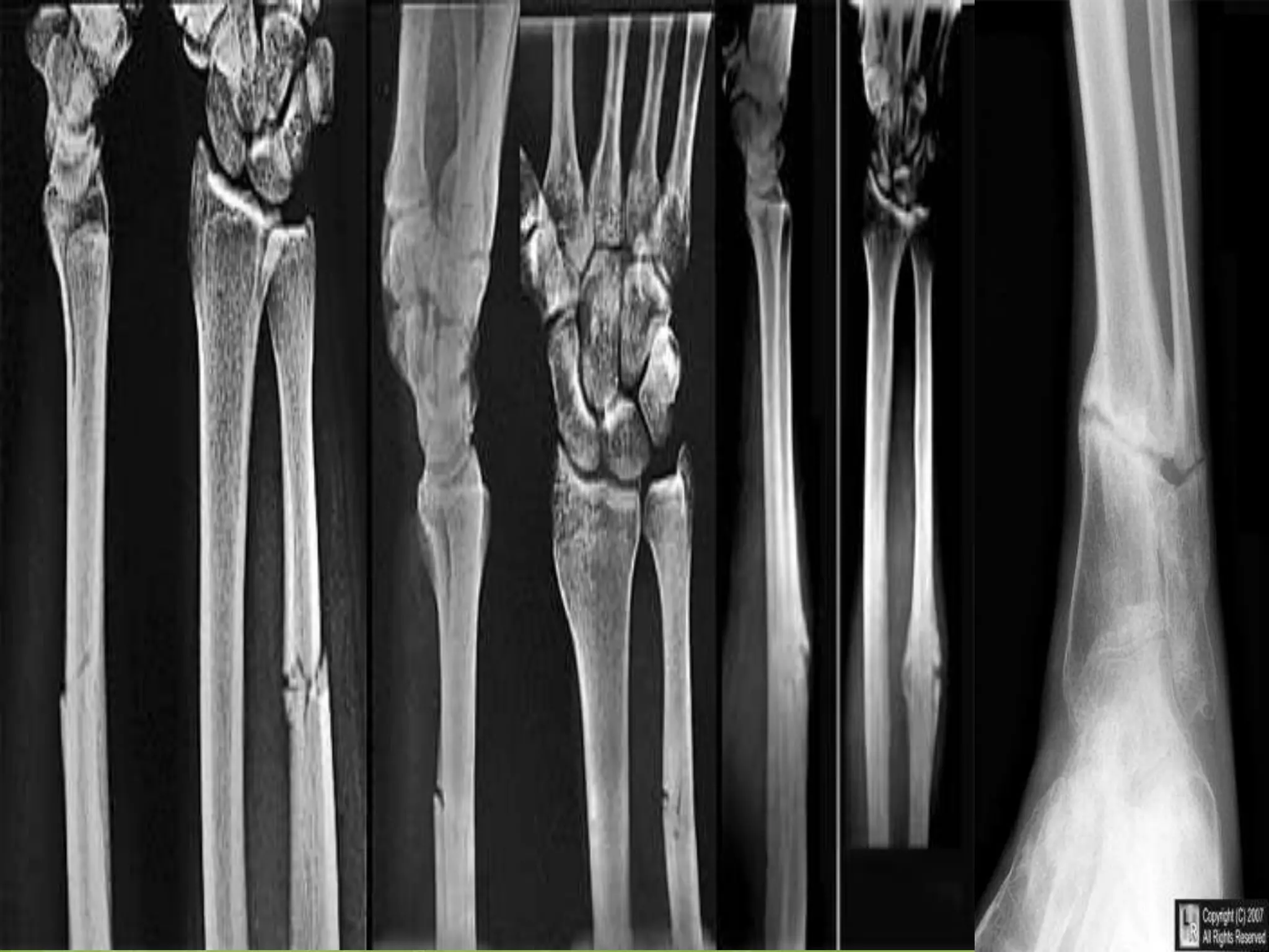 Early 5: HaemarthrosisBleeding into a joint spaces.Occurs if a joint is involved in the fracture.Presentation:swollen tense joint; the patient resists any attempt to moving ittreatment:blood aspiration before dealing with the fracture; to prevent the development of synovial adhesions.