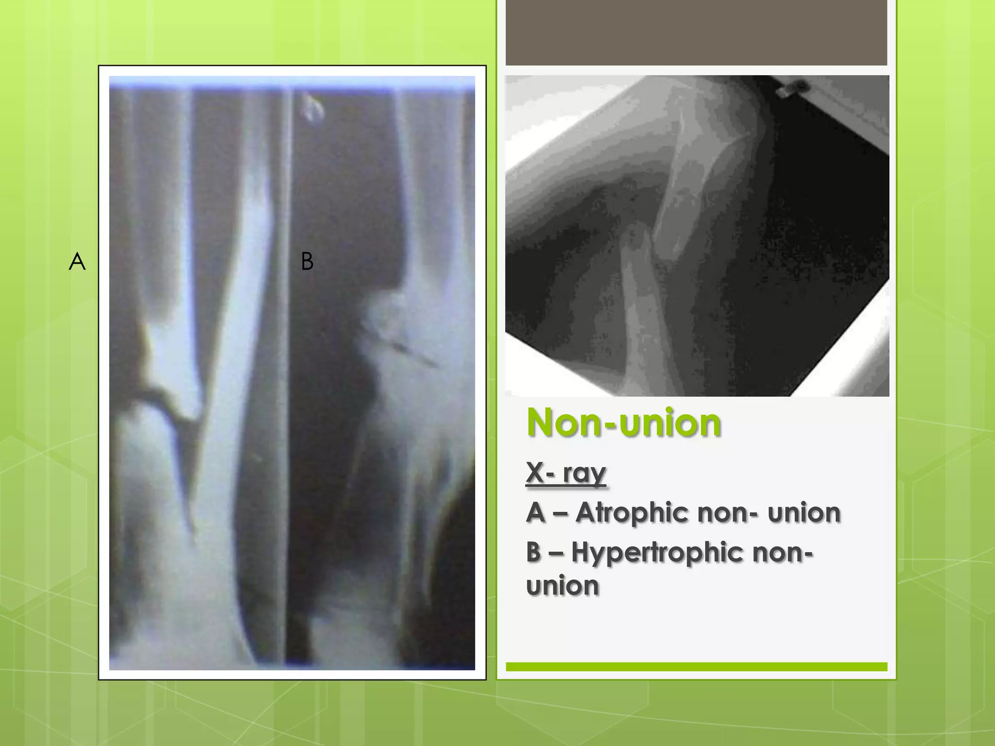 Clinical features:Tenderness persistAcute pain if bone is subjected to stress*( * ask pt to walk, move affected limb)X RAYS -visible line# and very little callus               formation/periosteal reaction        - bone ends are not sclerosed/ atrophic               (it will eventually unite)Late1: DELAYED UNION	