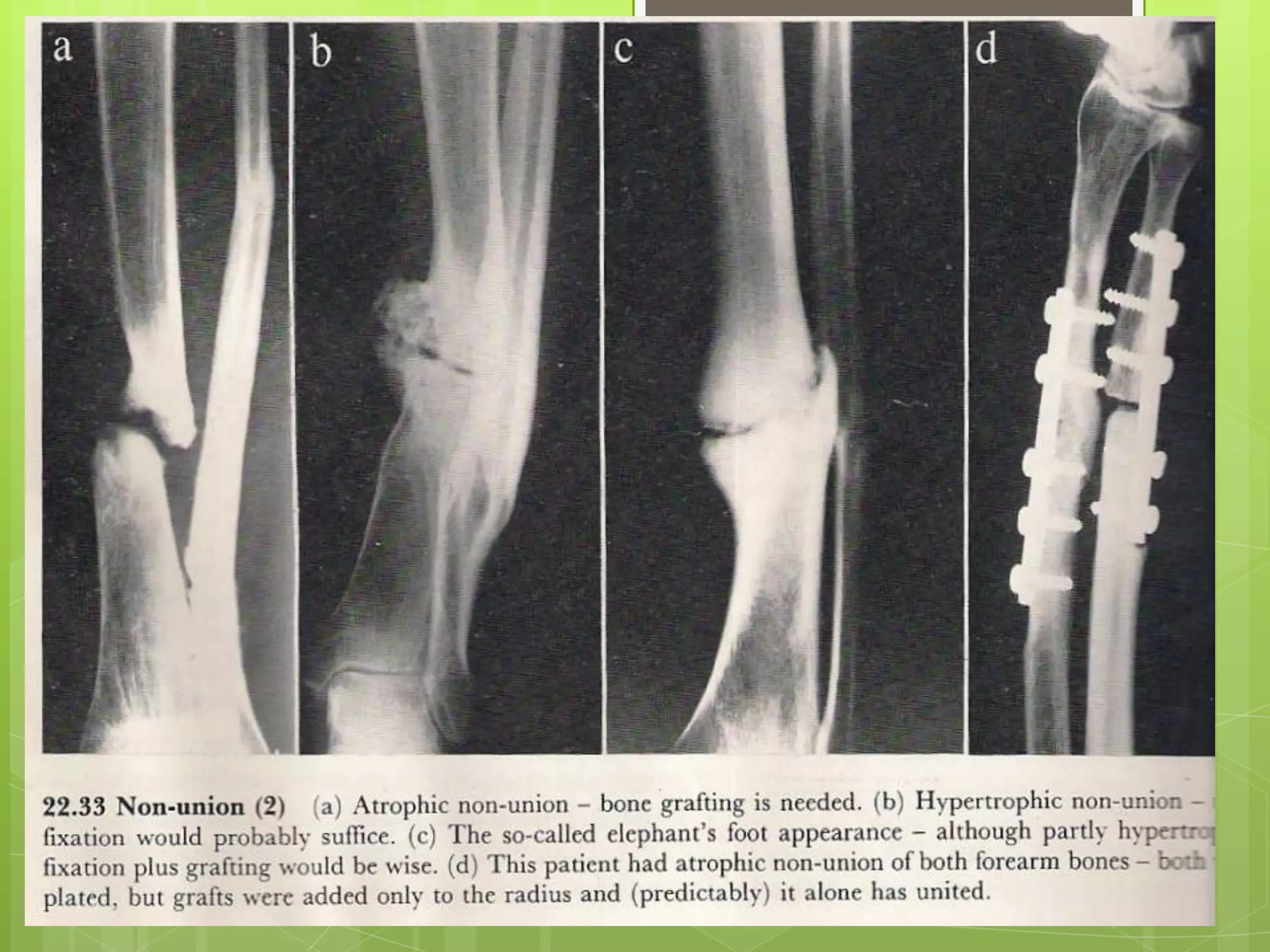  Late 2 : NON-UNIONIn a minority of cases, delayed union--non-unionFactors contributing to non-union:-inadequate treatment of delayed union too large gapinterposition of soft tissues between the fragmentsThe growth has stopped and pain diminished- replaced by fibrous tissue - pseudoarthrosisTreatment :-conservative / operativeatrophic non-union – fixation and grafting hypertrophic non-union – rigid fixation