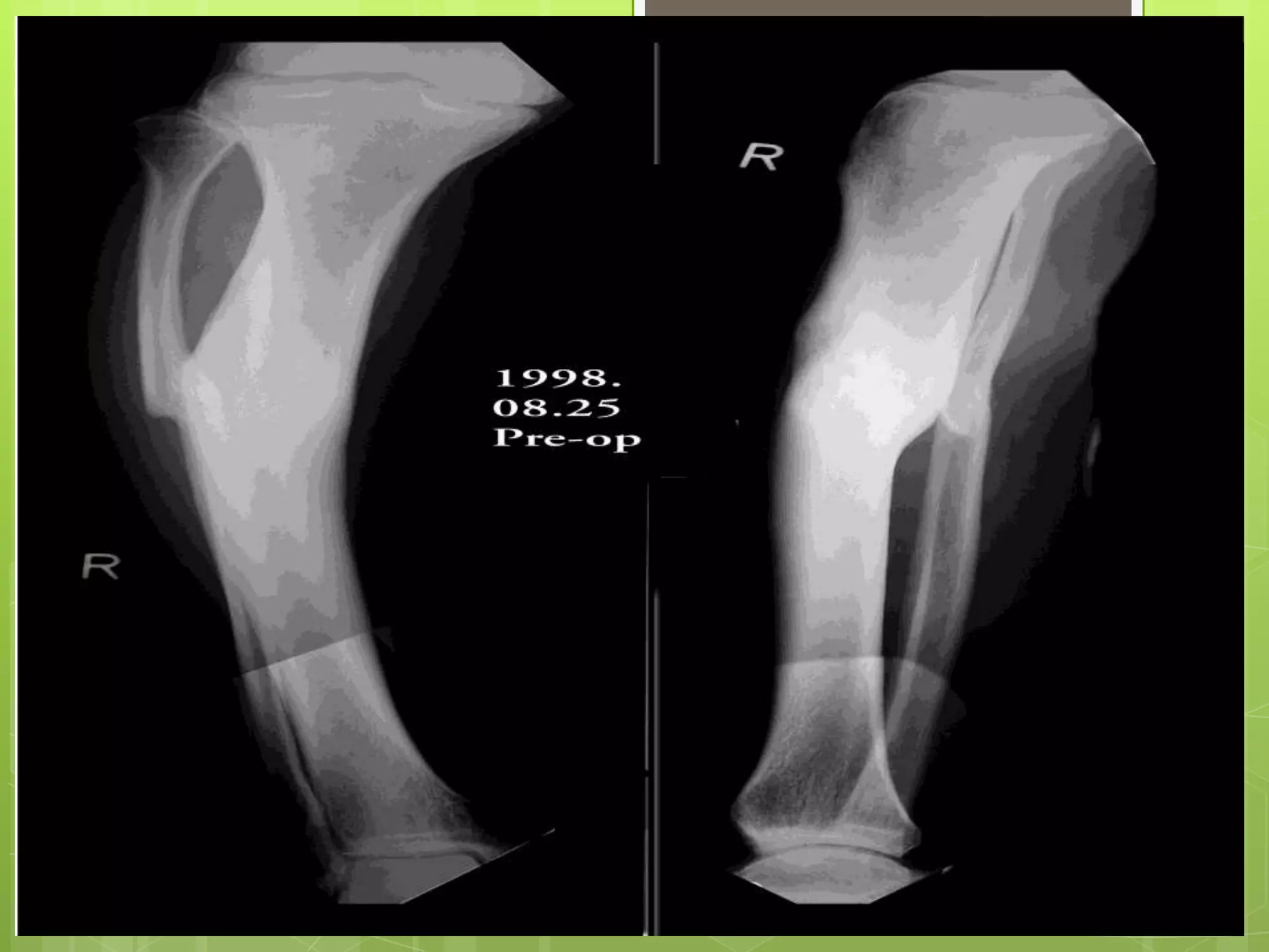 Late 2: NON UNIONbone ends are rounded off or exuberantHypertrophic non unionBone ends are enlarged, osteogenesis is still active but not capable of bridging the gap‘elephant feet’ on X rayAtrophic non unionCessation of osteogenesisNo suggestion of new bone formation