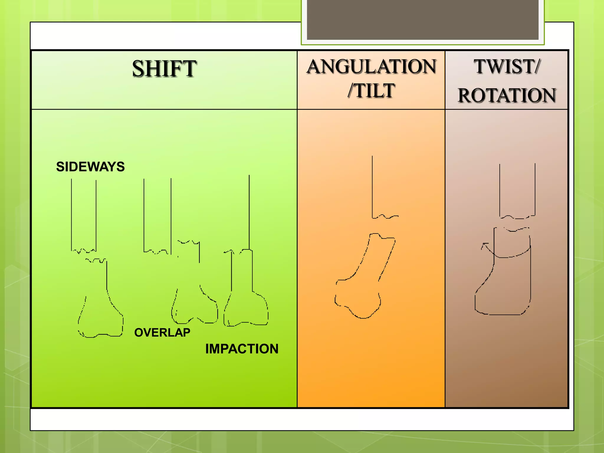 SIDEWAYSOVERLAPIMPACTION