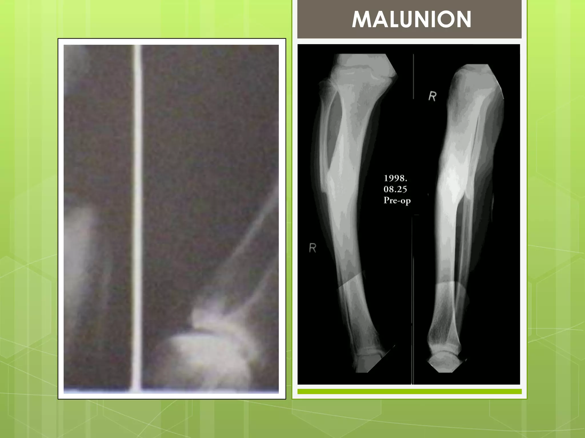 Late 2: Non unionTx:Mostly symptomlessConservativeRemovable splintFor hypertrophic non-union, functional bracing-induce unionPulsed electromagnetic fields and low frequency pulsed u/s can also be used to stimulate union.OperativeHypertrophic--Rigid fixation (internal or  external)Atrophic--Excision of fibrous tissue ,sclerotic tissue at bone end, bone grafts packed around the fracture 