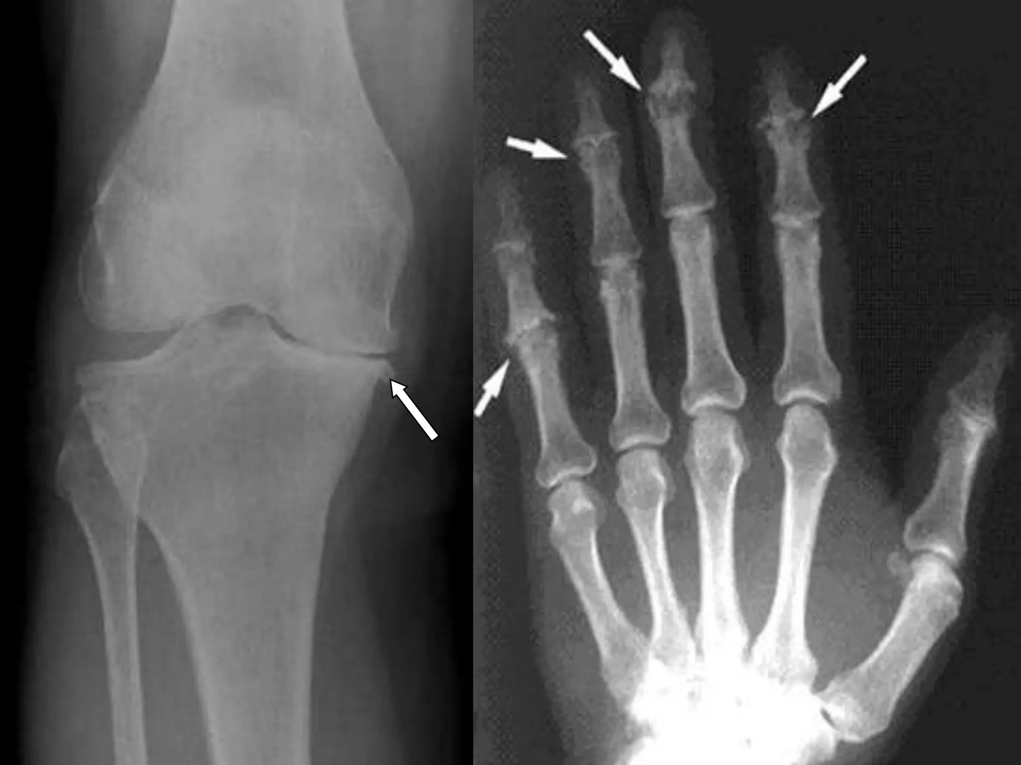 Late 4: AVASCULAR NECROSISCertain region-known for their propensity to develop ischaemia and bone necrosisHead of femur Proximal part of scaphoidLunateBody of talus(Actually this is an early complication however the clinical and radiological effects are not seen until weeks or even months)No clinical feature of avascular necrosis but if there is a failure to unite or bone collapse-pain