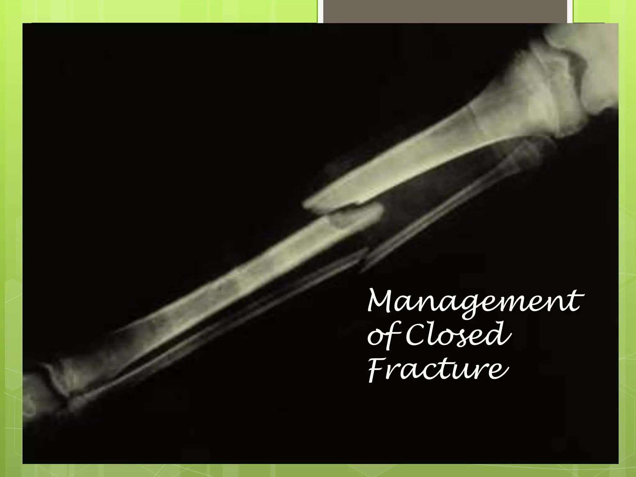 Management of Closed Fracture