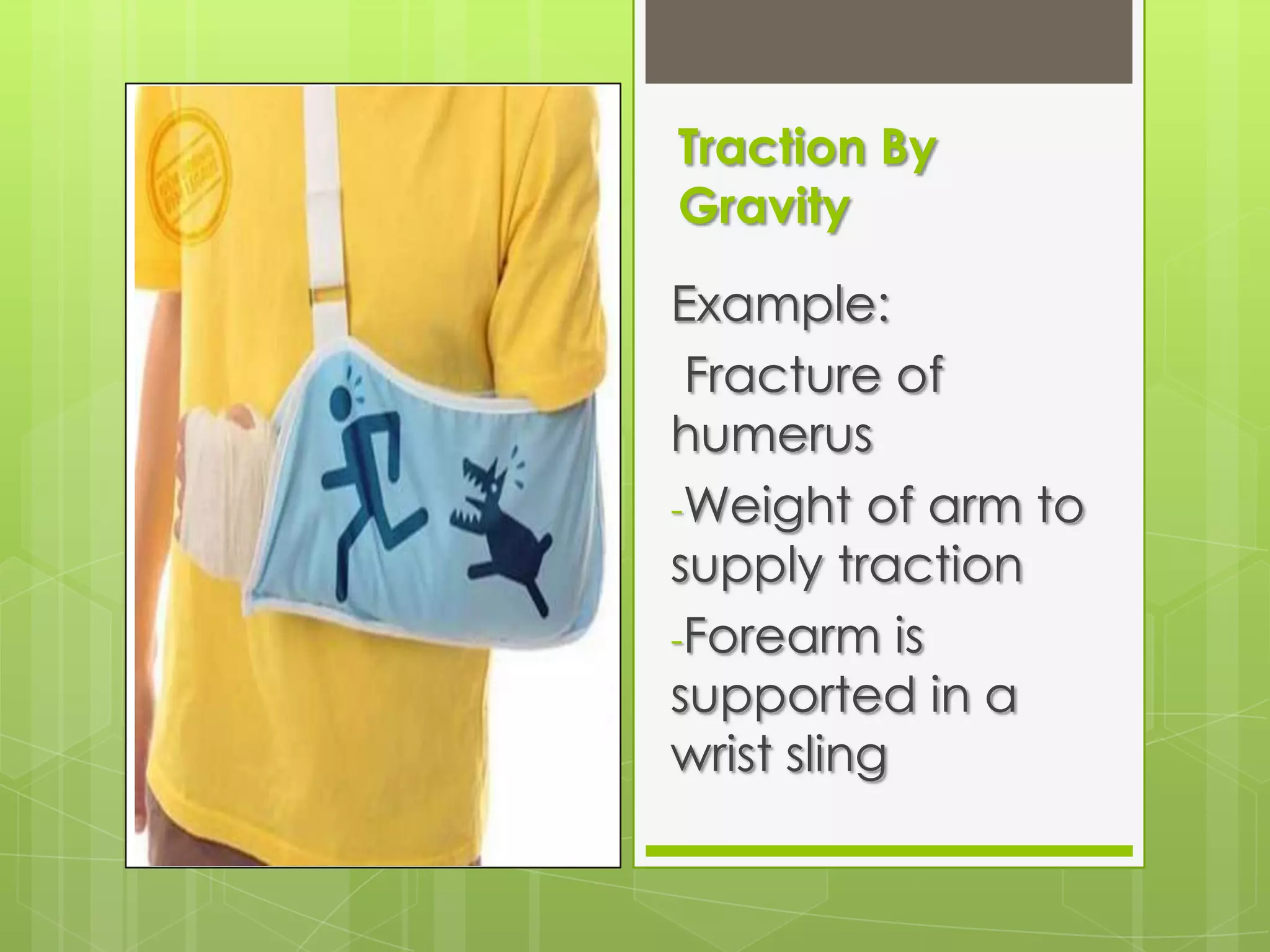 Traction By GravityExample: Fracture of humerusWeight of arm to supply traction