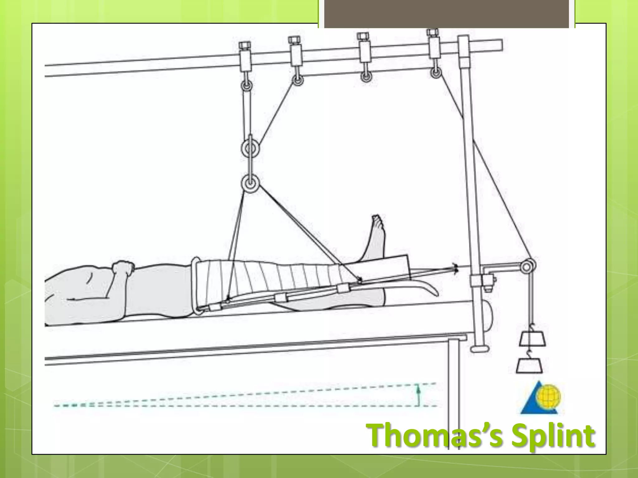 Thomas’s Splint