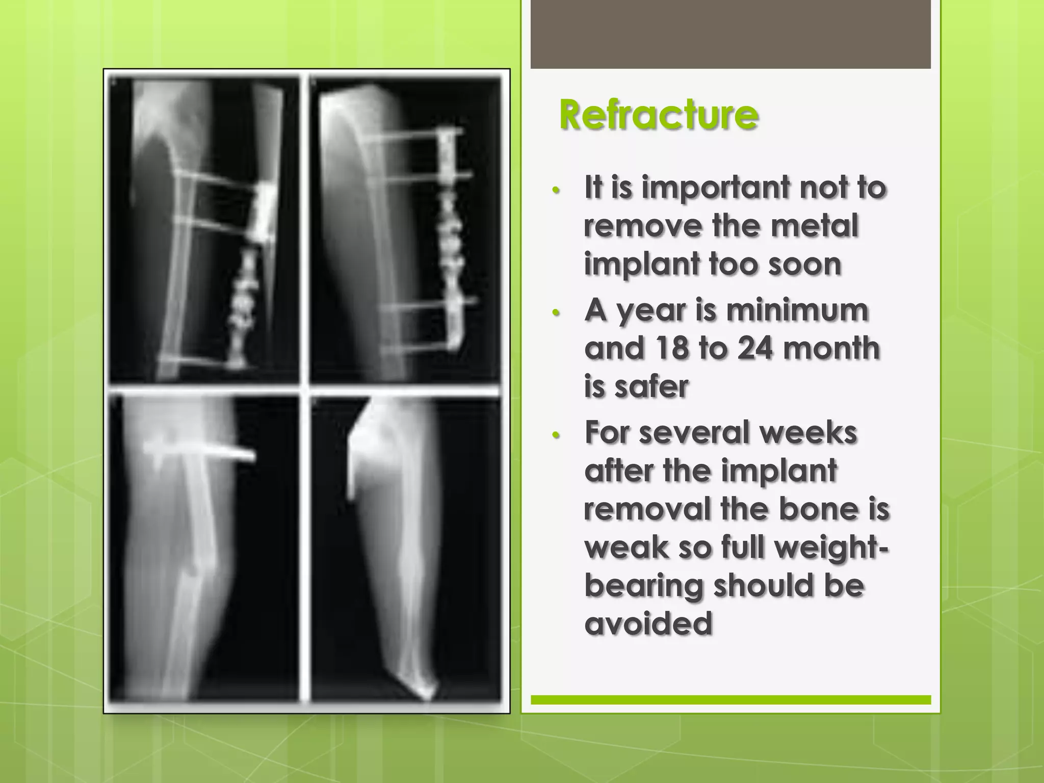 So, undue stress should therefore be avoided until the fragment  has united.