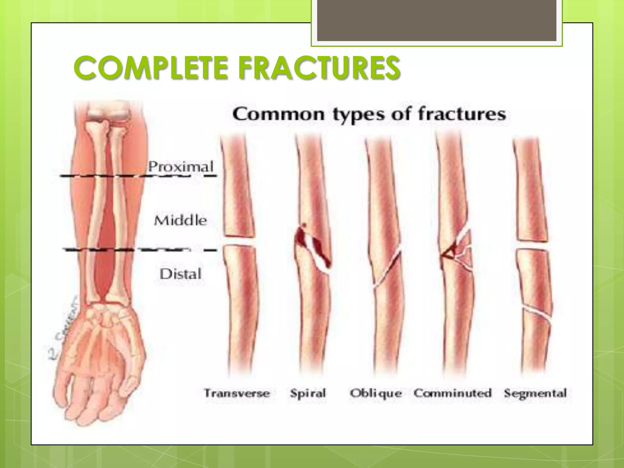 COMPLETE FRACTURES