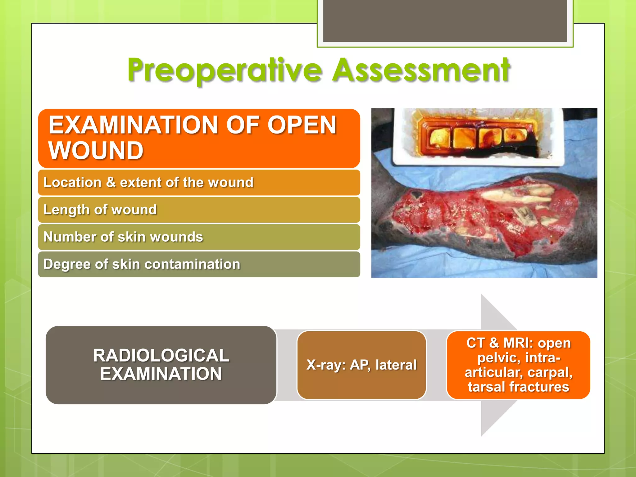 Open Fractures Classification