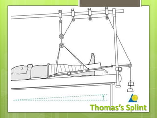 Tss Splint Complication of fracture | PPTX