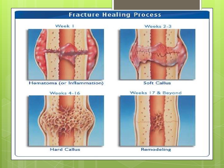 complication of fracture complication of fracture, Muscles