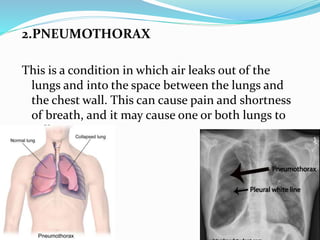 2.PNEUMOTHORAX
This is a condition in which air leaks out of the
lungs and into the space between the lungs and
the chest wall. This can cause pain and shortness
of breath, and it may cause one or both lungs to
collapse.
 