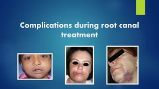 Complications during root canal
treatment
 