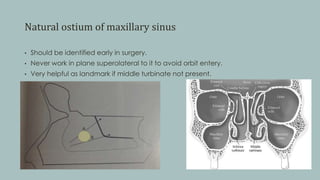 Natural ostium of maxillary sinus
• Should be identified early in surgery.
• Never work in plane superolateral to it to avoid orbit entery.
• Very helpful as landmark if middle turbinate not present.
 
