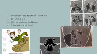 • Anatomical consideration of skull base
A. Low skull base
B. Curved posterior skull base.
C. Sphenoethmoidal cell.
 