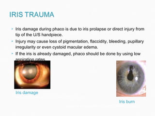Iris damage during phaco is due to iris prolapse or direct injury from tip of the U/S handpiece. Injury may cause loss of pigmentation, flaccidity, bleeding, pupillary irregularity or even cystoid macular edema. If the iris is already damaged, phaco should be done by using low aspiration rates. eyeworld.org/images/New_Articles/2010/04/29_b.jpg Iris damage www.retinalphysician.com/archive%5C2010%5CJun Iris burn  