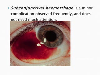 Subconjunctival haemorrhage   is a minor complication observed frequently, and does not need much attention. whatisguide.net 